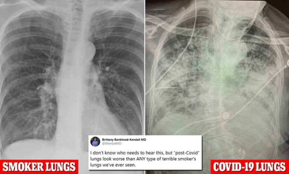 Post-Covid Lungs Look FAR WORSE Than ‘Any Type Of Terrible Smoker Lungs’